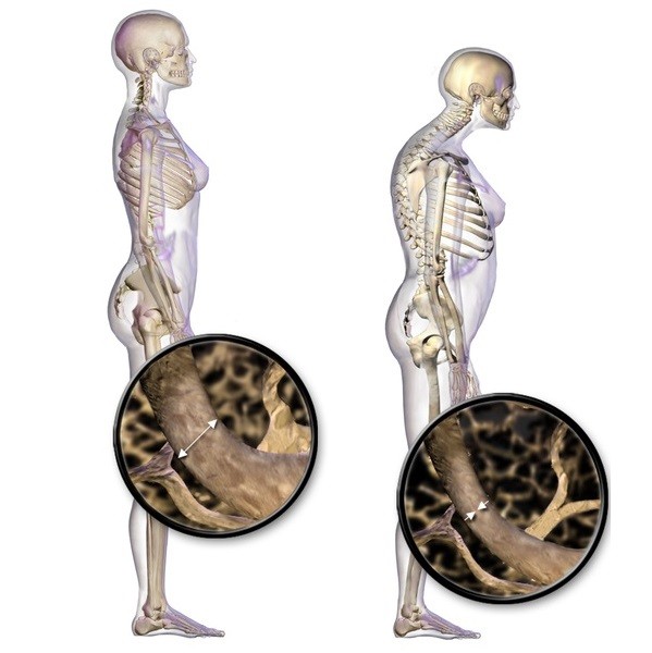 Osteoporoza - cauze, simptome si tratament | CENTROKINETIC